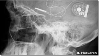 120503113321_implante_oxford_304x171_r.maclaren