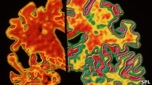 Cerebro con Alzheimer
