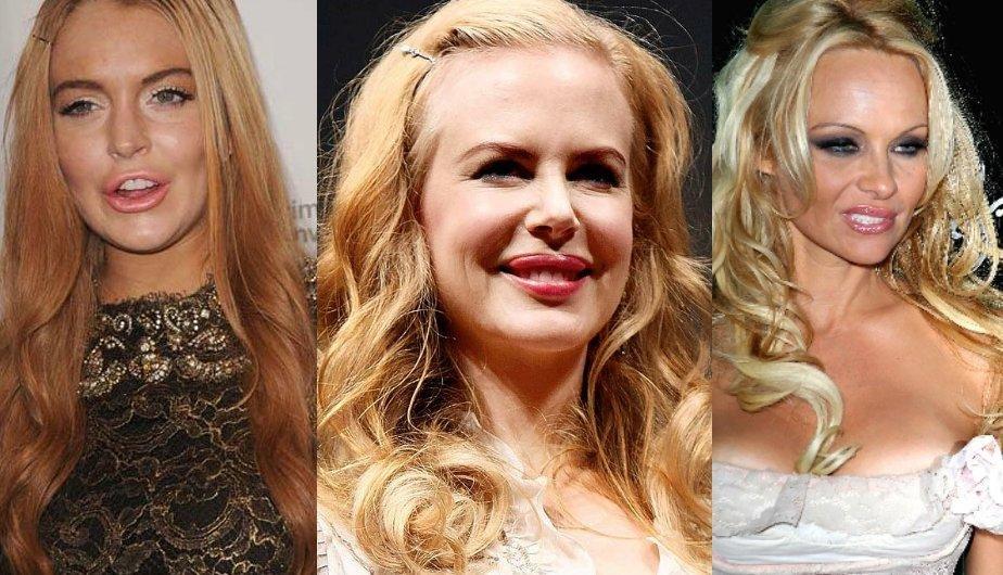 Las famosas son el mejor ejemplo de lo terrible que es abusar del botox (FOTOS)