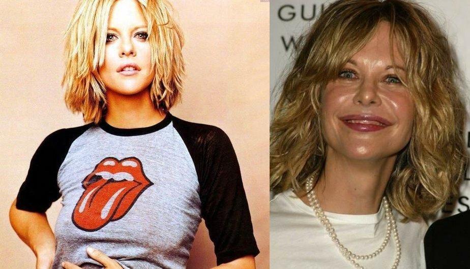 Las famosas son el mejor ejemplo de lo terrible que es abusar del botox (FOTOS)