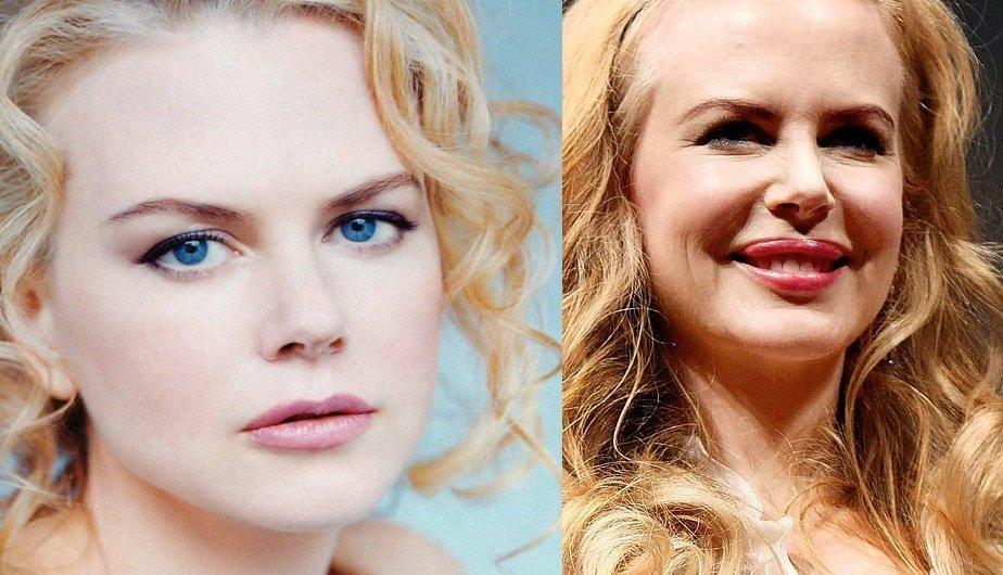 Las famosas son el mejor ejemplo de lo terrible que es abusar del botox (FOTOS)