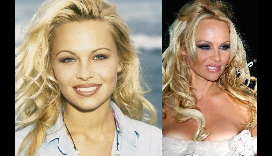 Las famosas son el mejor ejemplo de lo terrible que es abusar del botox (FOTOS)