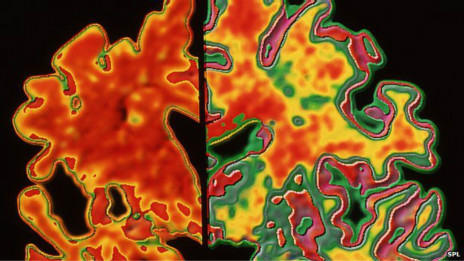 Escáner de un cerebro con Alzheimer y uno normal.
