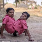 Conjoined-twins-Shivanath-Shivram-Sahu-20140411231322