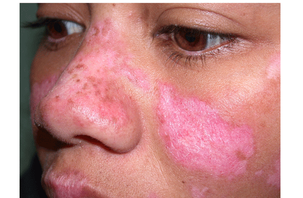 De 10 enfermos con lupus, 9 son mujeres