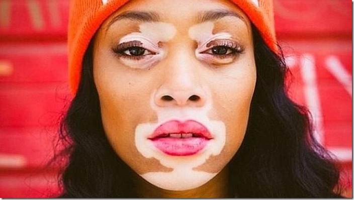 modelo-vitiligo3-