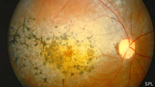 Manchas en la visión son una de las dolencias que produce la retinosis pigmentaria.