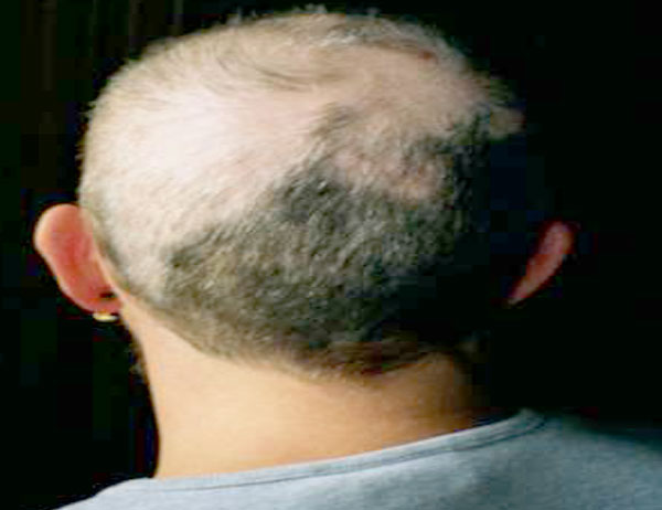 ¿Qué es la tricotilomanía?