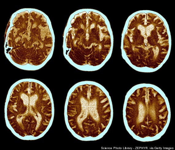 alzheimers brain
