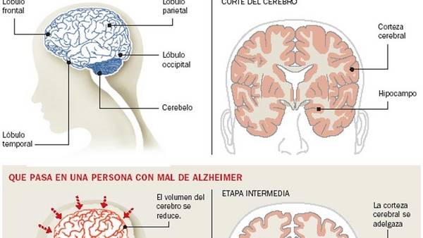 Infografía. Qué pasa en una persona que sufre Alzheimer.