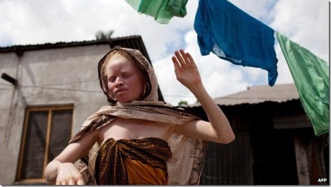 Los albinos son discriminados en Tanzania