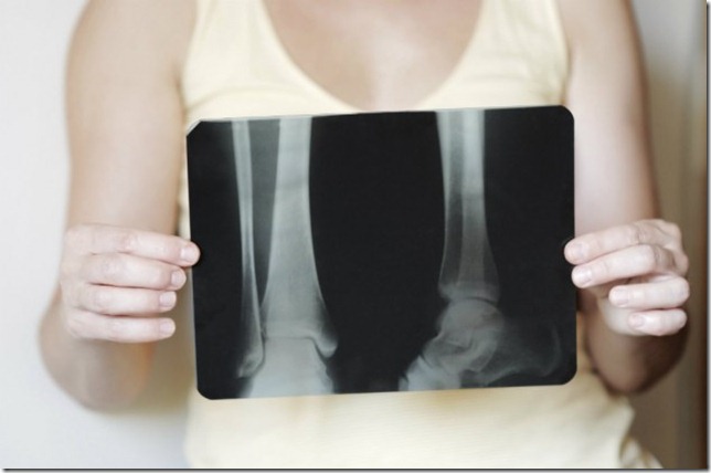 Que-es-la-osteopetrosis-1
