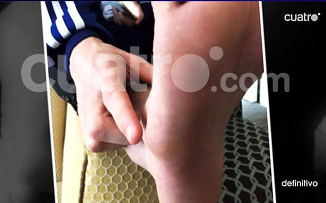 La inflamación en el pie de Messi