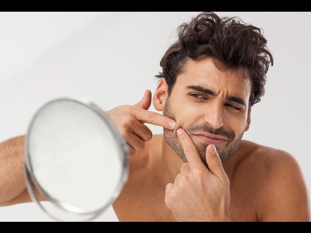 5 maneras de prevenir la presencia del acné