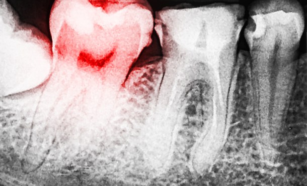 Así eran los dentistas de hace 14.000 años