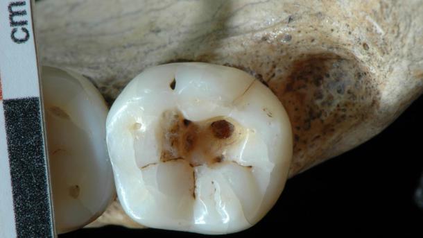 dentistas prehistçoricos