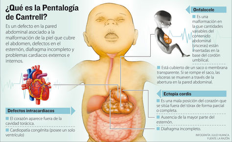 Info Pentalogía de Cantrell.