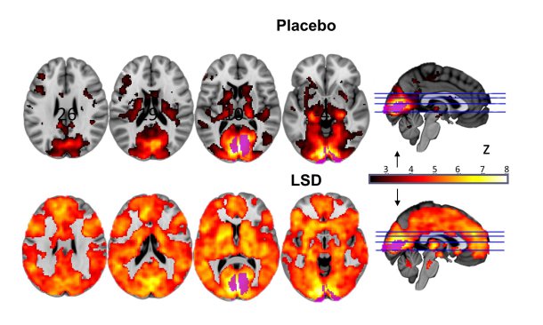 LSD en el cerebro