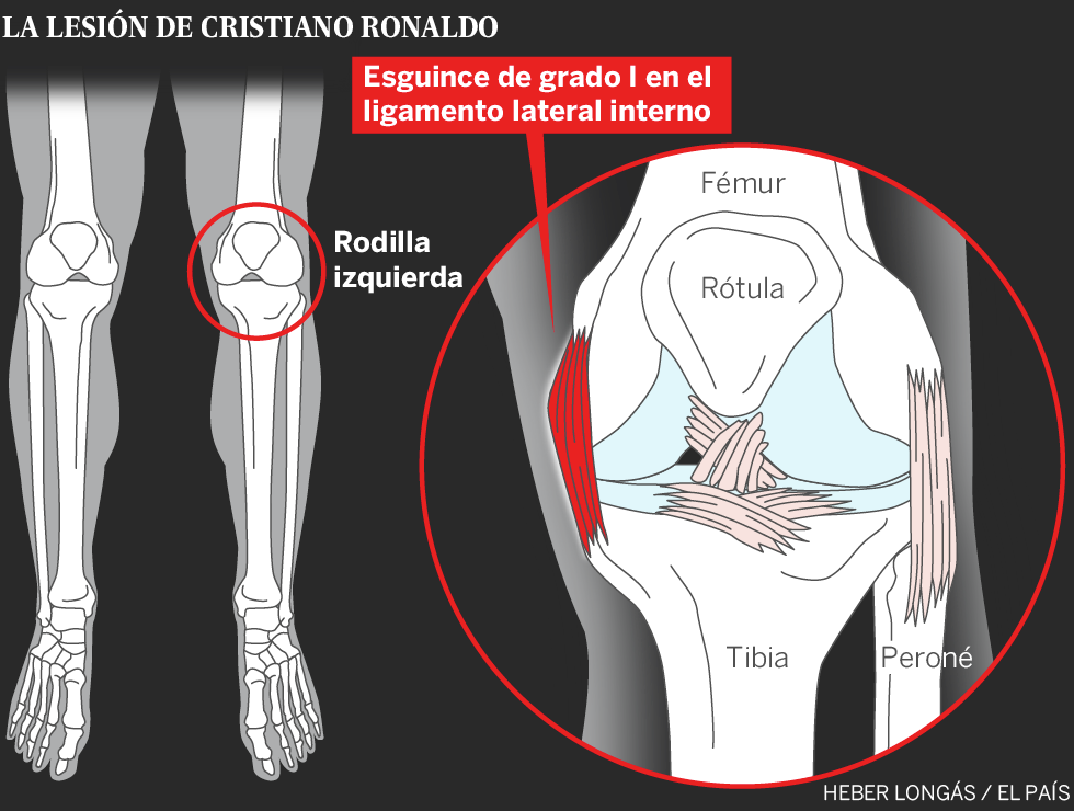Lesión de rodilla de Cristiano Ronaldo: esguince de ligamento latera interno