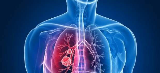 6 posibles causas del cáncer de pulmón