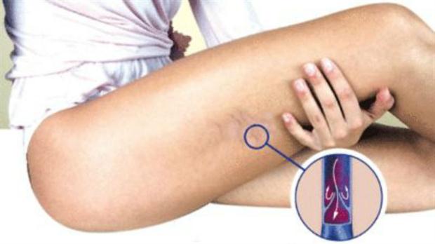 La trombosis es la formación de un coágulo en una vena o arteria que obstruye la circulación de la sangre