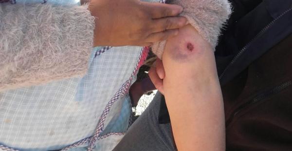 Una mujer muestra una herida de balín, que recibió durante los enfrentamientos en Viloco