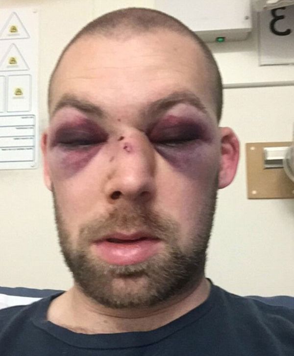 Así quedó el rostro de Alex Tait