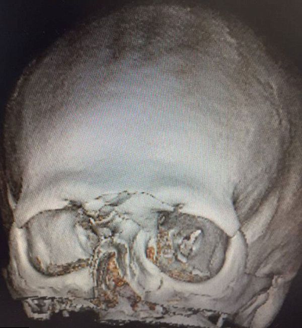 La radiografía el cráneo de Tait