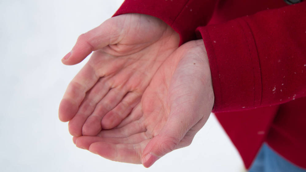 Foto: Manos con síndrome de Raynaud. (iStock)