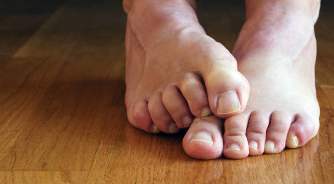 Dedos de los pies blanquecinos. (iStock)