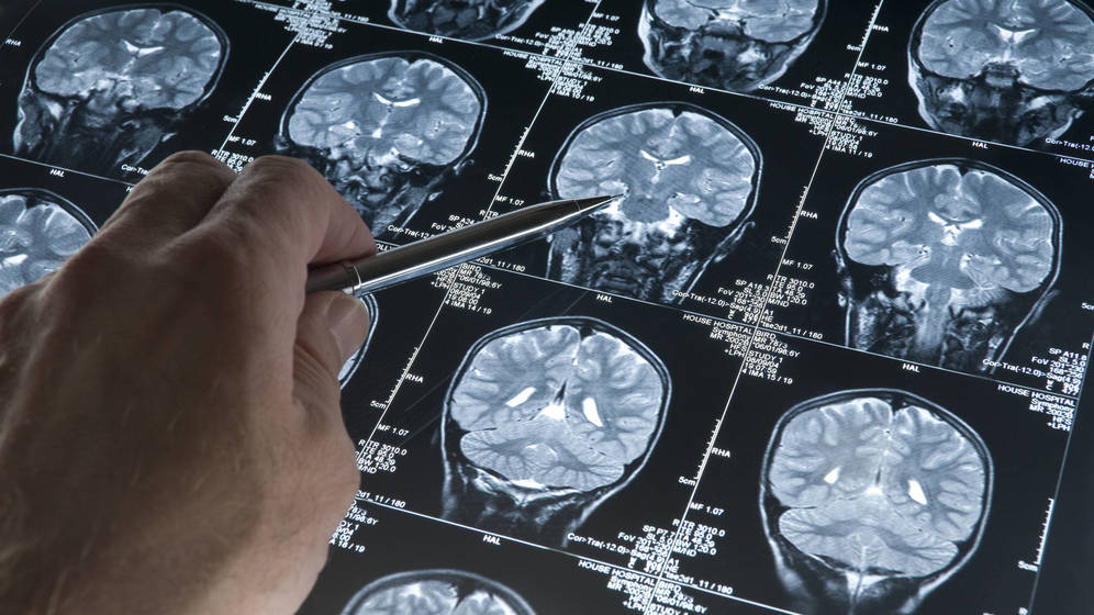 Foto: Más de 46 millones de personas sufren de Alzheimer en el mundo. (iStock)