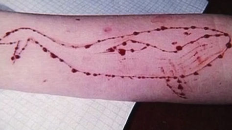 Autolesión de una adolescente en la que muestra los cortes que se realizó en el antebrazo para formar una ballena.