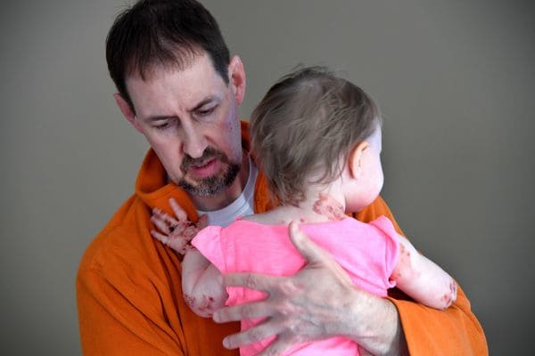 Kevin Federici sostiene a su hija Elizabeth, con cuidado de no rozar su delicada piel. (Katherine Frey/ The Washington Post)