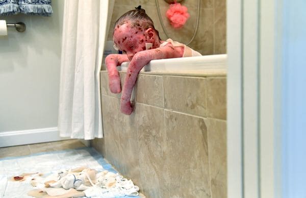 Una de cada 20.000 personas nace con EB, que se produce porque las células carecen de una proteína que mantiene unida a la piel. (Katherine Frey/Washington Post)