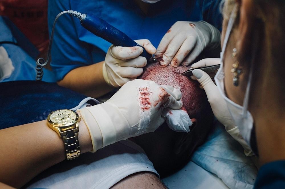transplante pelo clinica