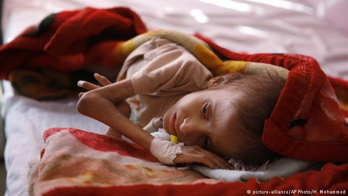 Jemen Kind Unterernährung (picture-alliance/AP Photo/H. Mohammed)