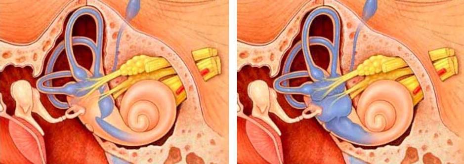 A la izquierda, un oído interno normal; a la derecha, con síndrome de Ménière. (Northwestern University)