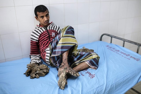 Abul Bajandar antes de las cirugías. (EFE)