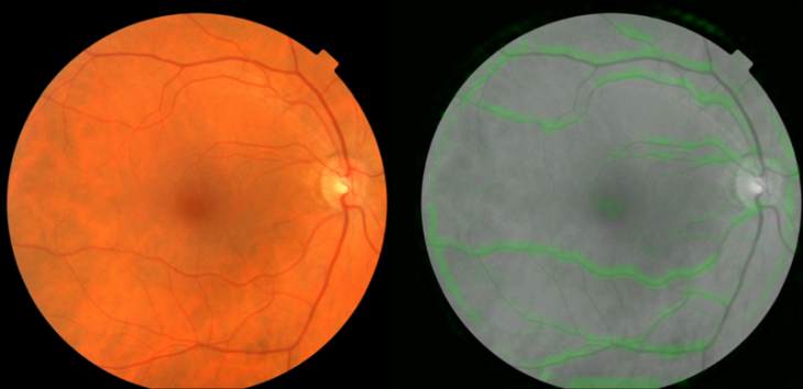 Imágen: fondos de un ojo. A la derecha, el algoritmo de Verily escoge vasos sanguíneos para la presión arterial. Crédito: Google/Verly