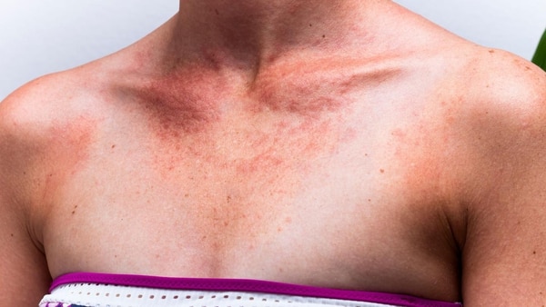 Especialistas aseguran que “el sol provoca daños progresivos y los rayos recibidos tienen repercusiones décadas después, por lo que deberíamos fomentar hábitos de protección”