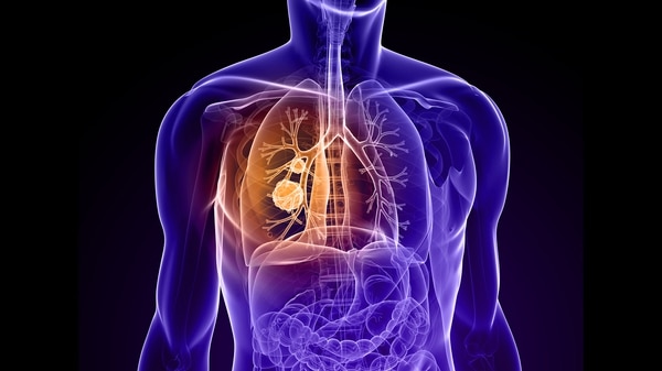 El principal factor de riesgo para cáncer pulmonar es el tabaquismo, aunque existen otros como la exposición a agentes cancerígenos