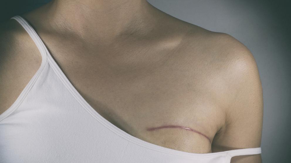 El hospital del Mar estrena la técnica que trata el cáncer de mama en una sola sesión de radioterapia