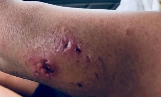 Así quedó el brazo de Katarina Zarutskie tras ser mordida por el tiburón