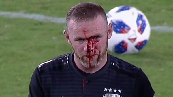 Rooney recibió cinco puntos de sutura