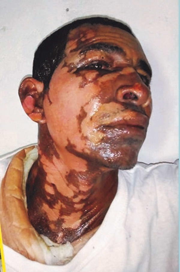 Pedro José Vanegas Jiménez presenta quemaduras de segundo y tercer grado en su rostro y cuello.
