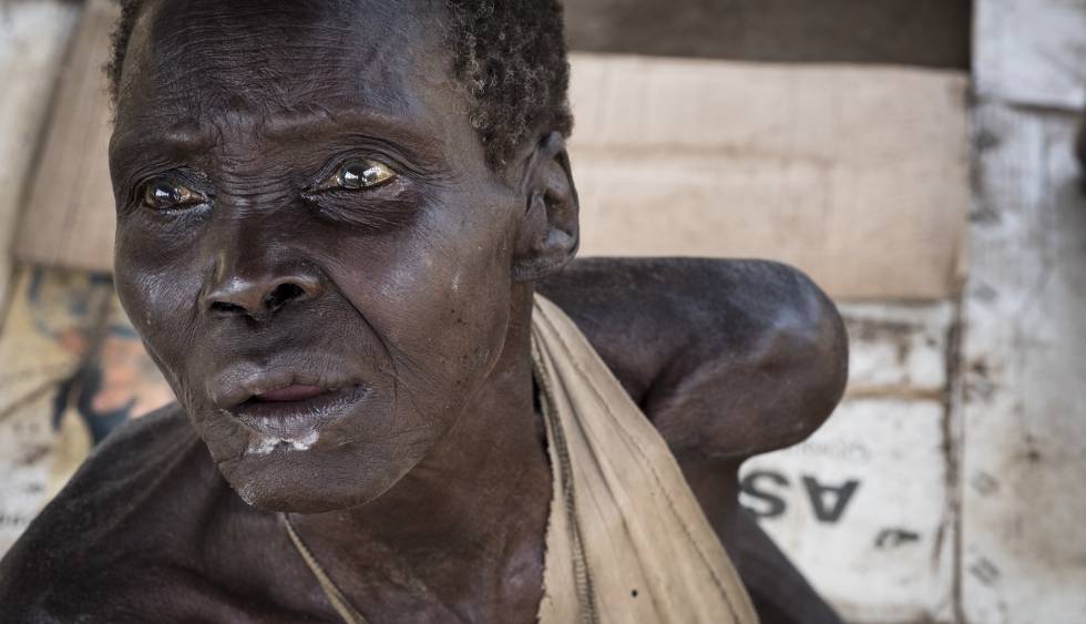 Como tantos sudaneses del sur, esta anciana sufre de inanición. Desde la crisis de 2013, los dos bandos rivales mantienen un enfrentamiento que ha costado al país una guerra civil, combates, enfermedades y hambre.