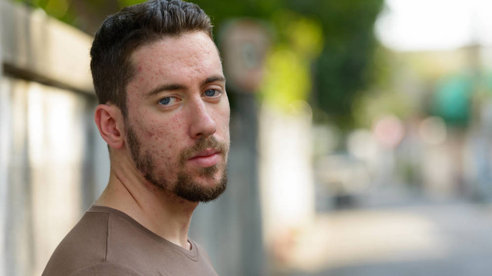 Foto: Acné adulto. (iStock)