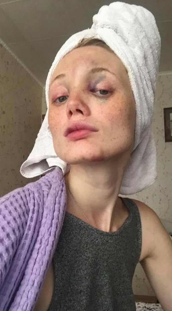 La modelo estuvo dos meses más con su novio, a pesar de la fuerte golpiza (Fotos: Kira Dice/Facebook)