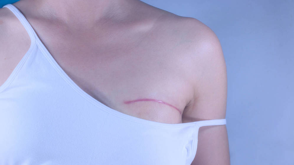 Foto: Cicatriz de una mastectomía. (iStock)