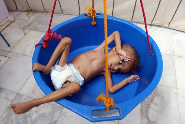 Un niño yemení gravemente desnutrido. Yemen enfrenta una crisis humanitaria y millones de personas sufren las consecuencias de  (ESSA AHMED / AFP)